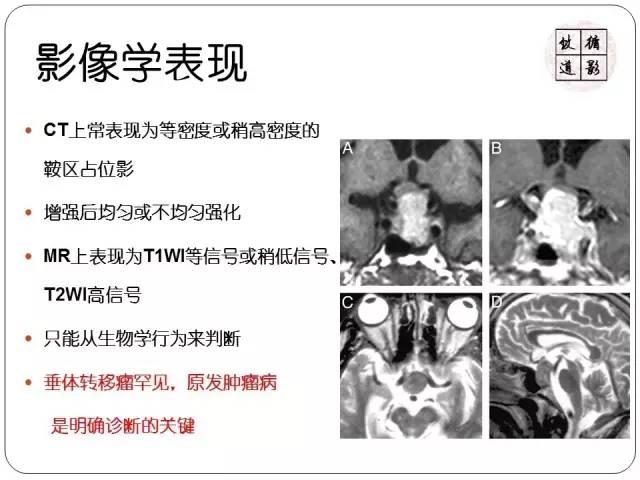 【病例】垂体转移瘤1例MR影像表现
