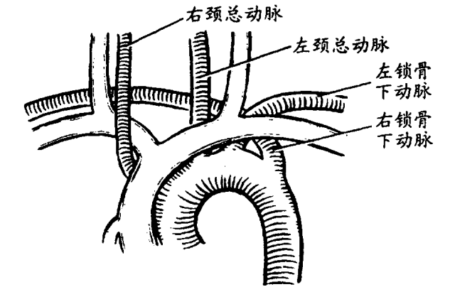 少见变异：迷走右锁骨下动脉