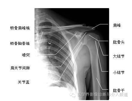 【病例】钙化性冈上肌腱炎1例X线MR影像表现 【病例】钙化性冈上肌腱炎1例X线MR影像表现