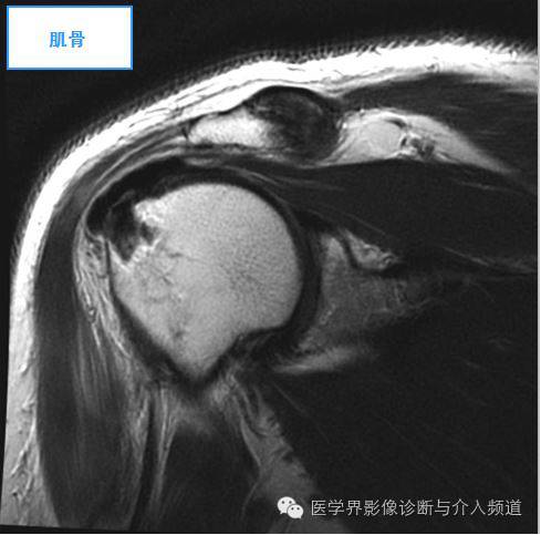 【病例】钙化性冈上肌腱炎1例X线MR影像表现 【病例】钙化性冈上肌腱炎1例X线MR影像表现