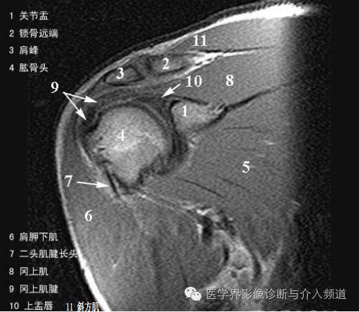 【病例】钙化性冈上肌腱炎1例X线MR影像表现 【病例】钙化性冈上肌腱炎1例X线MR影像表现