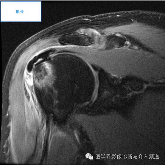 【病例】钙化性冈上肌腱炎1例X线MR影像表现 【病例】钙化性冈上肌腱炎1例X线MR影像表现