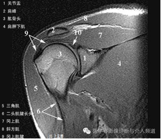 【病例】钙化性冈上肌腱炎1例X线MR影像表现 【病例】钙化性冈上肌腱炎1例X线MR影像表现