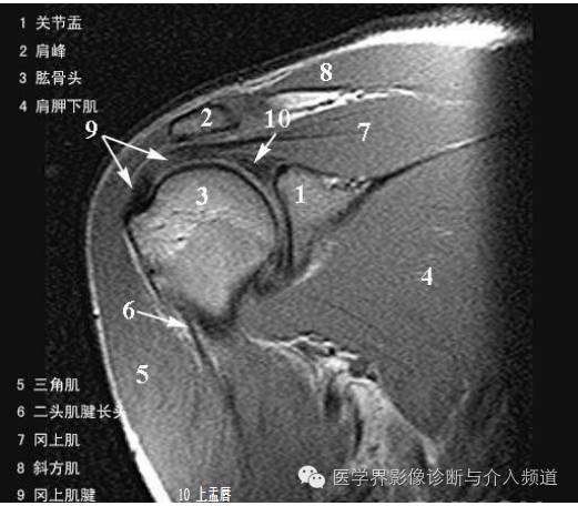 【病例】钙化性冈上肌腱炎1例X线MR影像表现 【病例】钙化性冈上肌腱炎1例X线MR影像表现