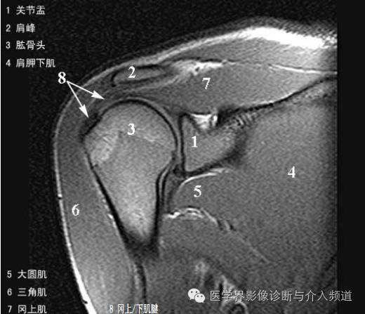 【病例】钙化性冈上肌腱炎1例X线MR影像表现 【病例】钙化性冈上肌腱炎1例X线MR影像表现