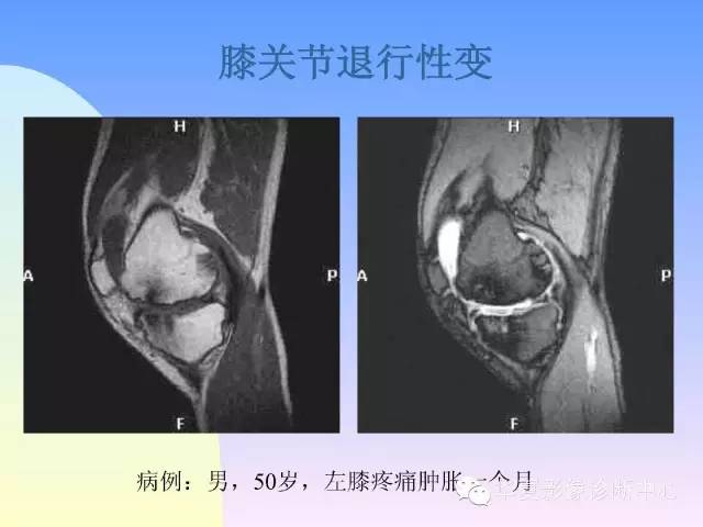 【PPT】膝关节常见疾病MRI诊断