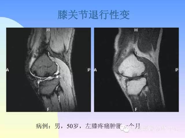 【PPT】膝关节常见疾病MRI诊断