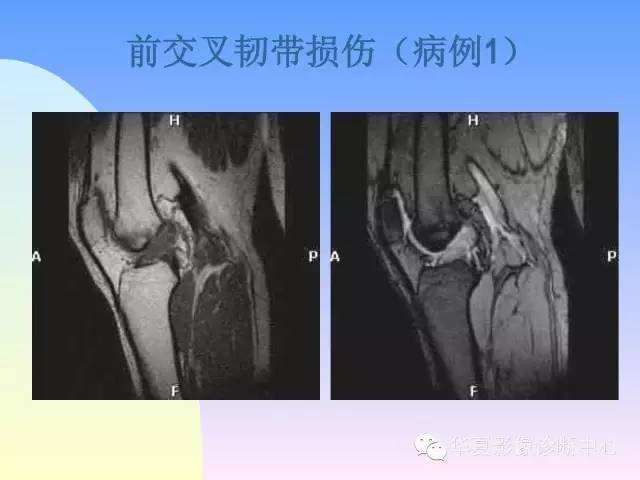 【PPT】膝关节常见疾病MRI诊断
