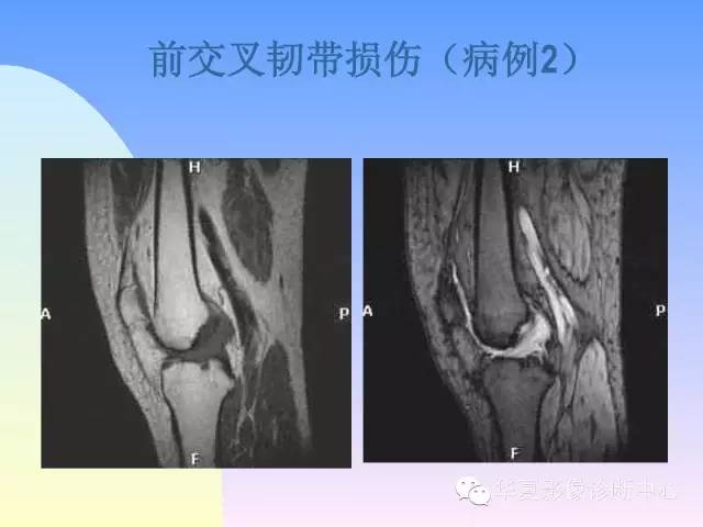 【PPT】膝关节常见疾病MRI诊断