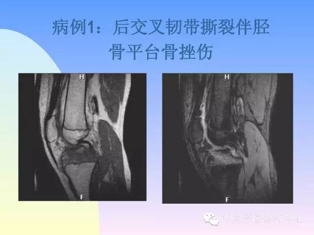 【PPT】膝关节常见疾病MRI诊断