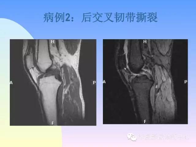 【PPT】膝关节常见疾病MRI诊断