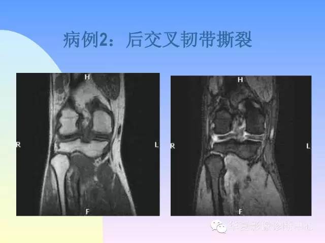 【PPT】膝关节常见疾病MRI诊断