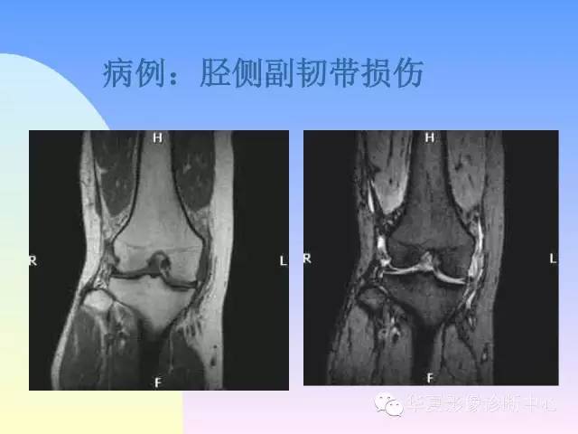 【PPT】膝关节常见疾病MRI诊断