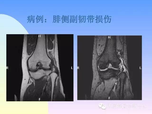 【PPT】膝关节常见疾病MRI诊断