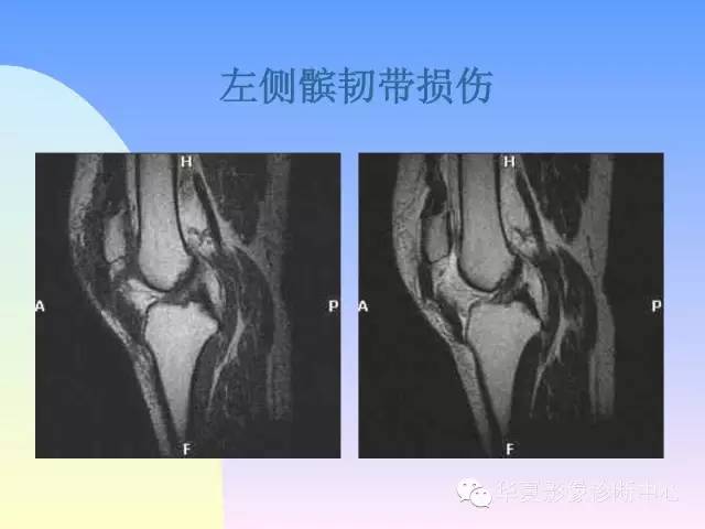 【PPT】膝关节常见疾病MRI诊断