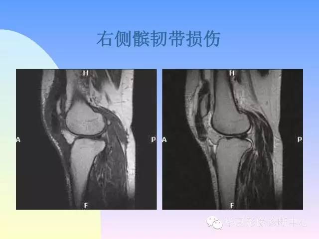 【PPT】膝关节常见疾病MRI诊断
