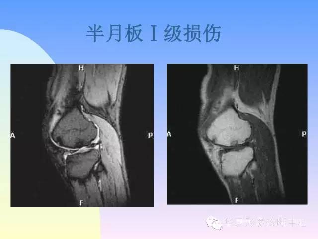 【PPT】膝关节常见疾病MRI诊断