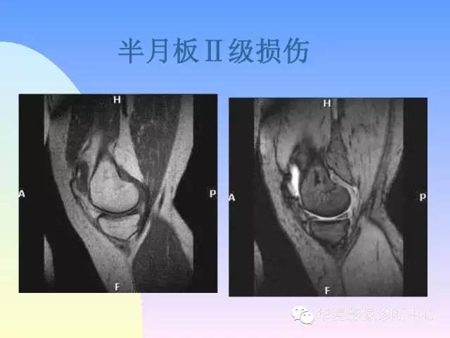【PPT】膝关节常见疾病MRI诊断