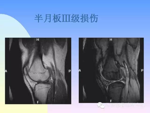 【PPT】膝关节常见疾病MRI诊断