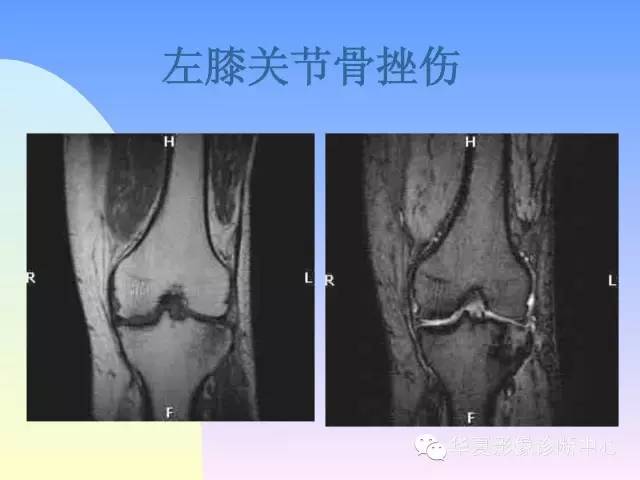 【PPT】膝关节常见疾病MRI诊断