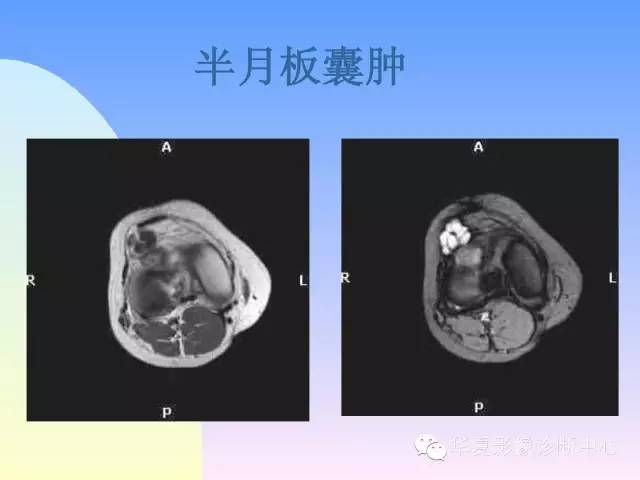 【PPT】膝关节常见疾病MRI诊断