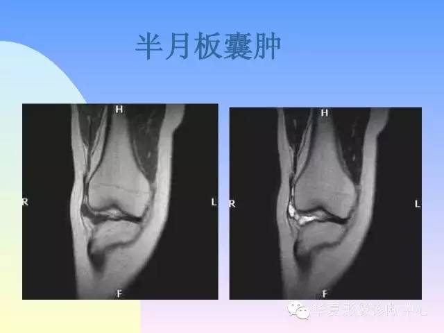 【PPT】膝关节常见疾病MRI诊断