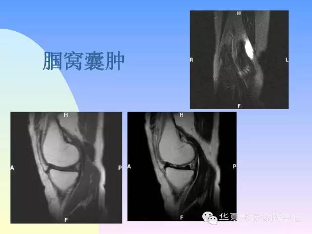 【PPT】膝关节常见疾病MRI诊断