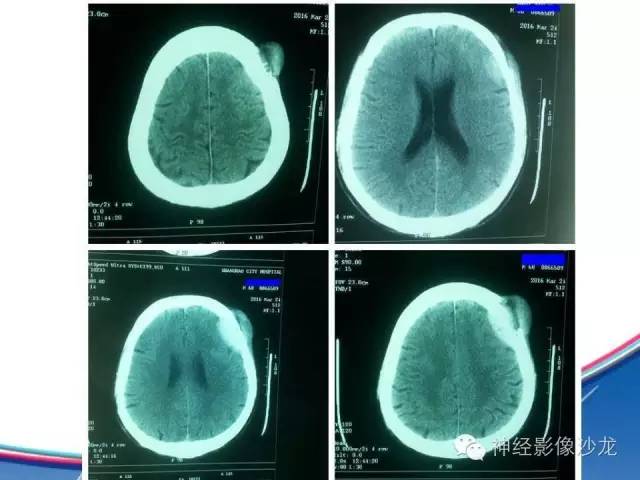 【病例】颅骨转移瘤1例CT及MR影像表现