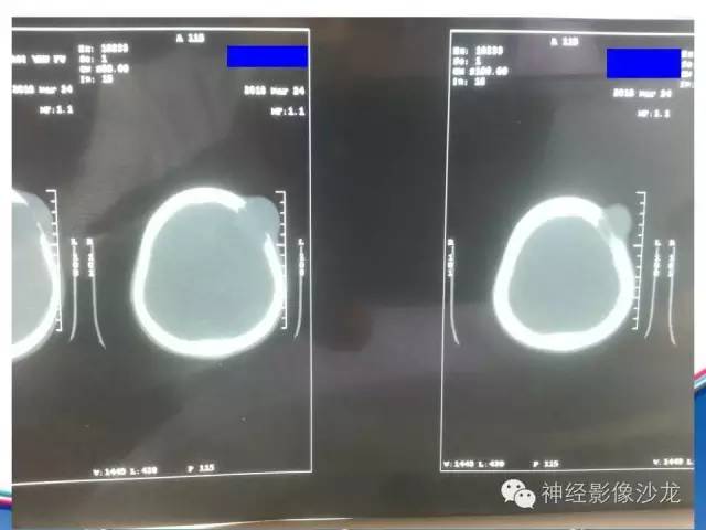 【病例】颅骨转移瘤1例CT及MR影像表现