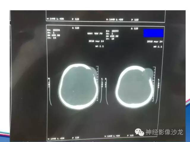 【病例】颅骨转移瘤1例CT及MR影像表现