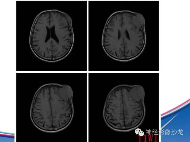 【病例】颅骨转移瘤1例CT及MR影像表现