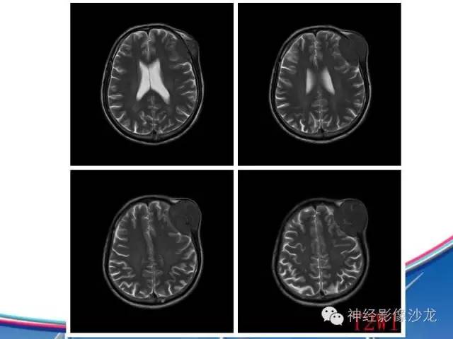 【病例】颅骨转移瘤1例CT及MR影像表现
