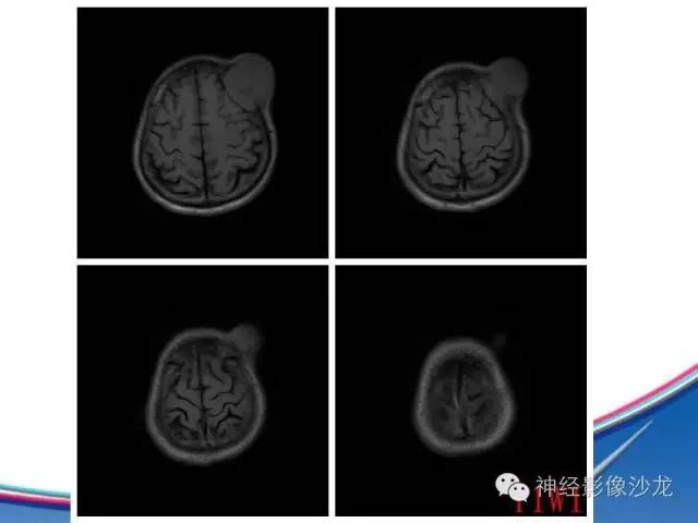【病例】颅骨转移瘤1例CT及MR影像表现