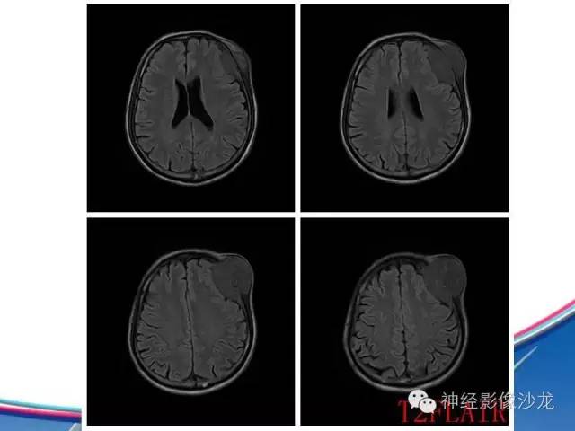 【病例】颅骨转移瘤1例CT及MR影像表现
