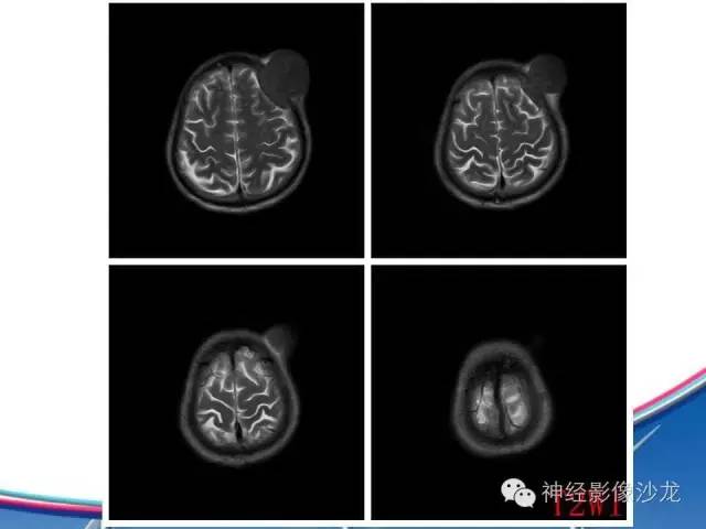 【病例】颅骨转移瘤1例CT及MR影像表现