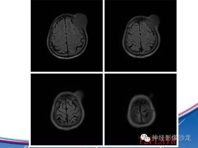 【病例】颅骨转移瘤1例CT及MR影像表现