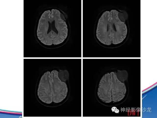 【病例】颅骨转移瘤1例CT及MR影像表现