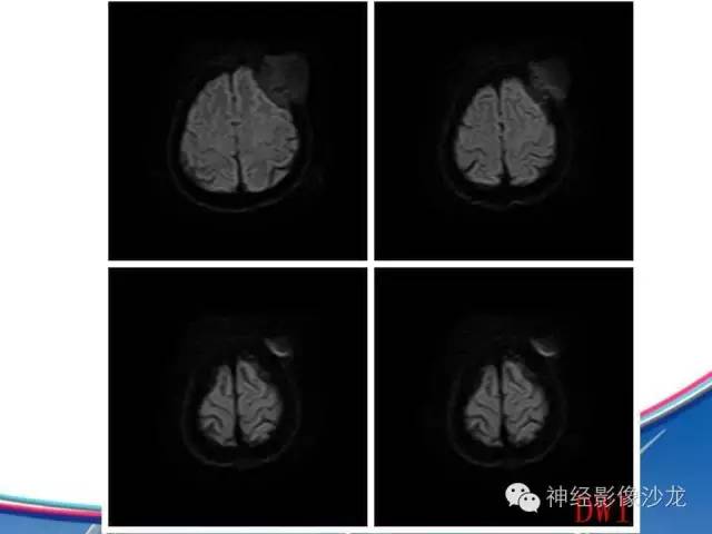 【病例】颅骨转移瘤1例CT及MR影像表现