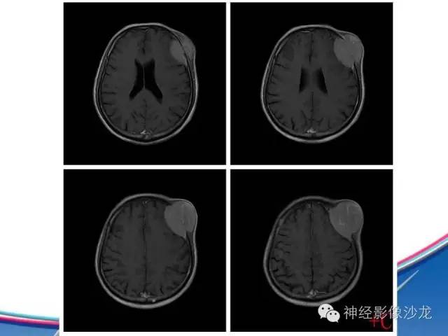 【病例】颅骨转移瘤1例CT及MR影像表现
