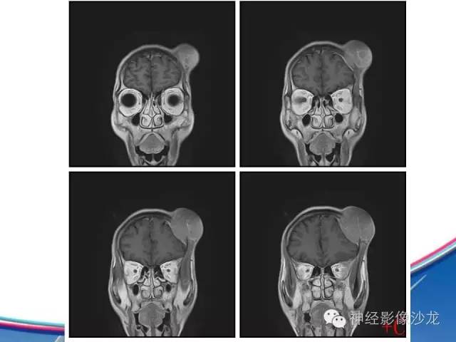 【病例】颅骨转移瘤1例CT及MR影像表现