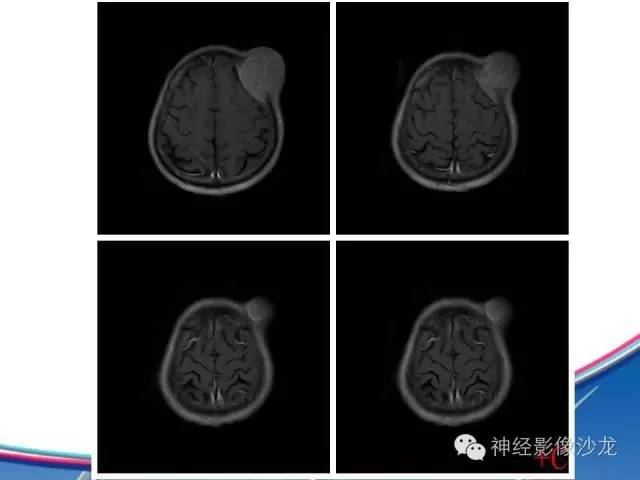 【病例】颅骨转移瘤1例CT及MR影像表现