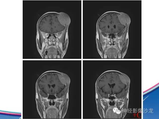 【病例】颅骨转移瘤1例CT及MR影像表现