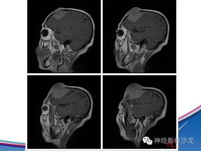 【病例】颅骨转移瘤1例CT及MR影像表现
