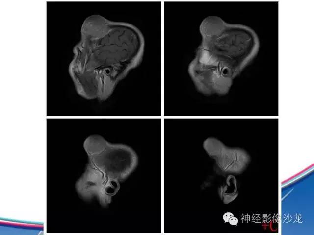 【病例】颅骨转移瘤1例CT及MR影像表现