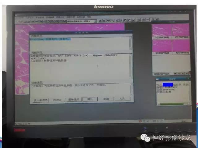【病例】颅骨转移瘤1例CT及MR影像表现
