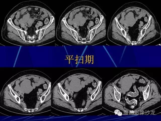 【病例】胃肠道间质瘤1例CT影像表现 【病例】胃肠道间质瘤1例CT影像表现