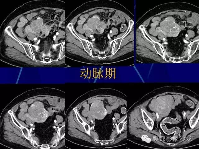 【病例】胃肠道间质瘤1例CT影像表现 【病例】胃肠道间质瘤1例CT影像表现