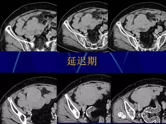 【病例】胃肠道间质瘤1例CT影像表现 【病例】胃肠道间质瘤1例CT影像表现
