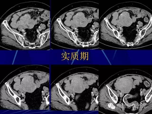 【病例】胃肠道间质瘤1例CT影像表现 【病例】胃肠道间质瘤1例CT影像表现