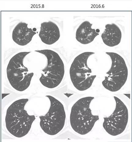 【病例】胸部结节性淋巴样组织增生1例